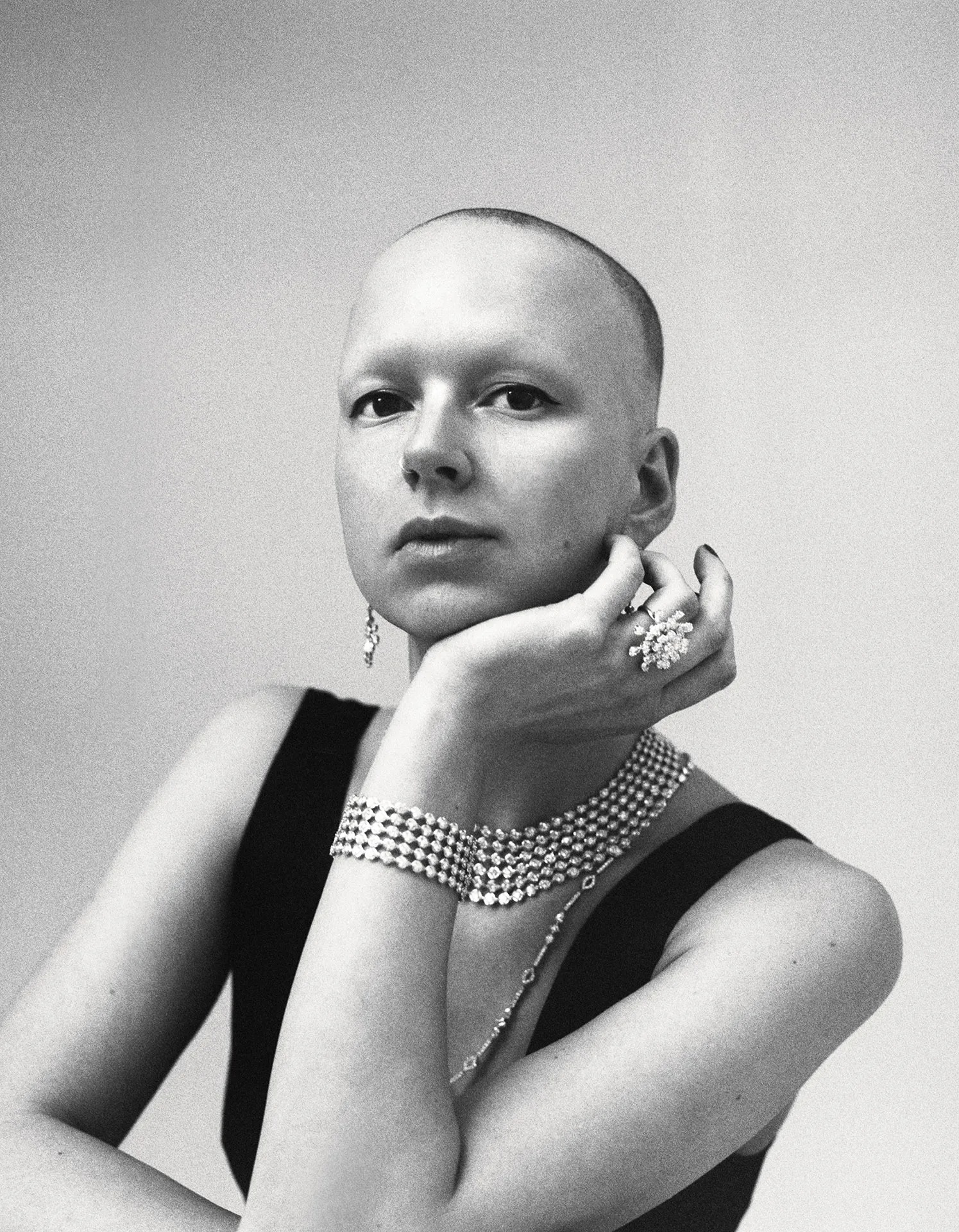 Baring All: The Reality of Growing Up With Alopecia 1 Picturestees Customized Gifts
